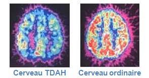 Désorganisation, distractivité et désinhibition : les défis du TDA/H chez l' adulte